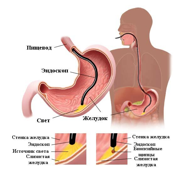 эндоскопия при эрозивном гастрите